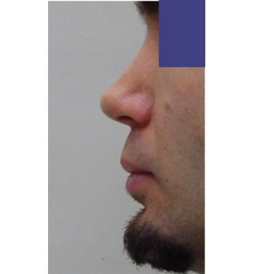 silicone revision rhinoplasty